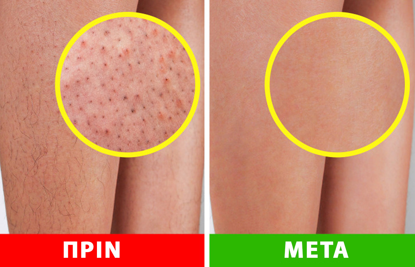 Όσα πρέπει να ξέρετε για τα «πόδια φράουλας» – Πώς να πείτε «αντίο» στις σκούρες κηλίδες