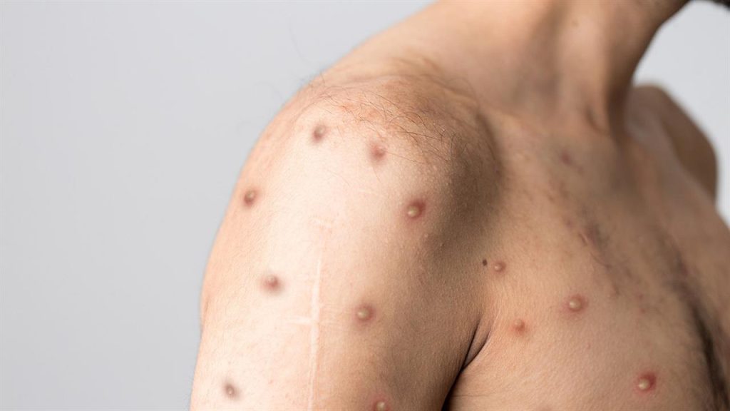 Το Λος Άντζελες ανακοίνωσε τον πρώτο θάνατο από την ευλογιά των πιθήκων – Ο δεύτερος στις ΗΠΑ