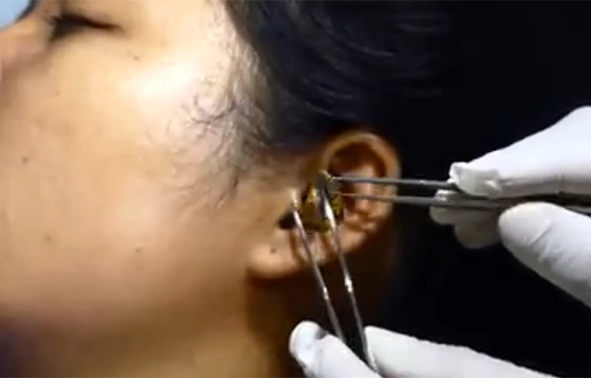 Ανατριχιαστικό: Η στιγμή που «χειρουργός» προσπαθεί να αφαιρέσει ζωντανό φίδι από το αυτί γυναίκας (βίντεο)