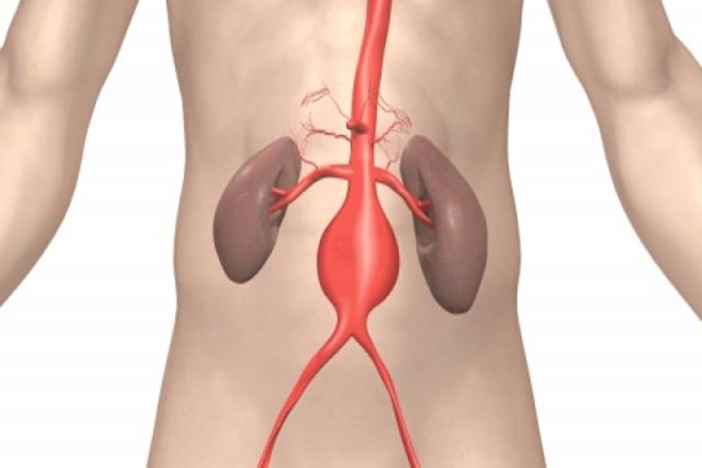 Οι 4 παράγοντες που προβλέπουν ότι το ανεύρυσμα θα σπάσει – Ποιες οι κατηγορίες