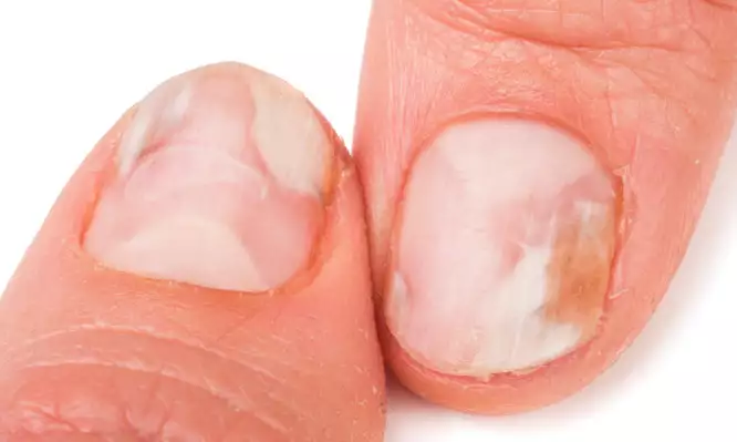 Μύκητες στα νύχια: Γιατί εμφανίζονται – Τα «κρυφά» συμπτώματα – Πως να τους αντιμετωπίσετε