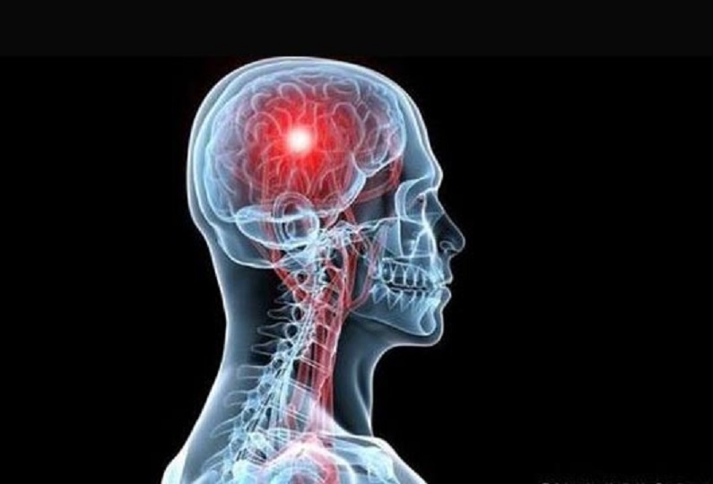 Εγκεφαλικό: Πού αλλού μπορεί να συμβεί εκτός από τον εγκέφαλο