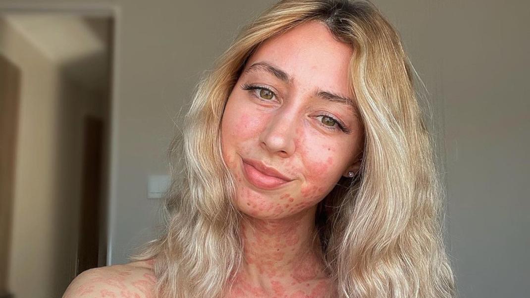 Η influencer με ψωρίαση στέλνει ένα δυνατό μήνυμα αποδοχής: «Φορέστε την ψωρίαση με περηφάνια» (φωτό)