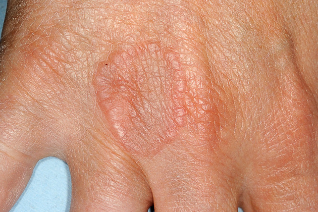 Δακτυλιοειδές κοκκίωμα: Οι τρεις τύποι που υπάρχουν & οι θεραπευτικές επιλογές