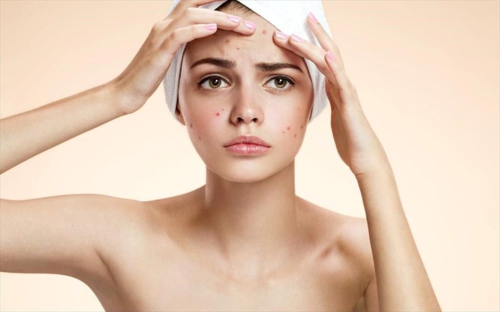 Αυτοί είναι οι πέντε μύθοι για την ακμή και τη διατροφή που καταρρίπτονται