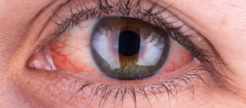 Κόκκινα μάτια: Το σημάδι μιας θανατηφόρας βικτωριανής ασθένειας