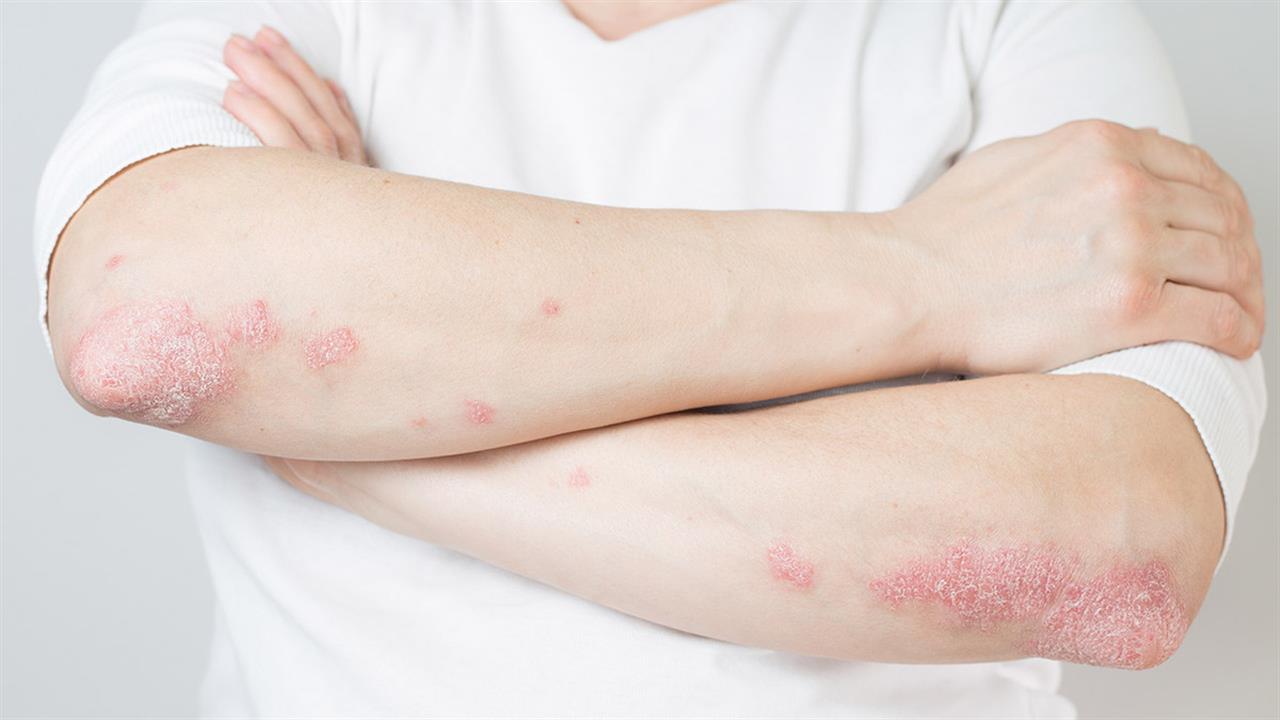 Ψωρίαση: Αυτές είναι οι αντιφλεγμονώδεις τροφές που βοηθούν στην αντιμετώπισή της