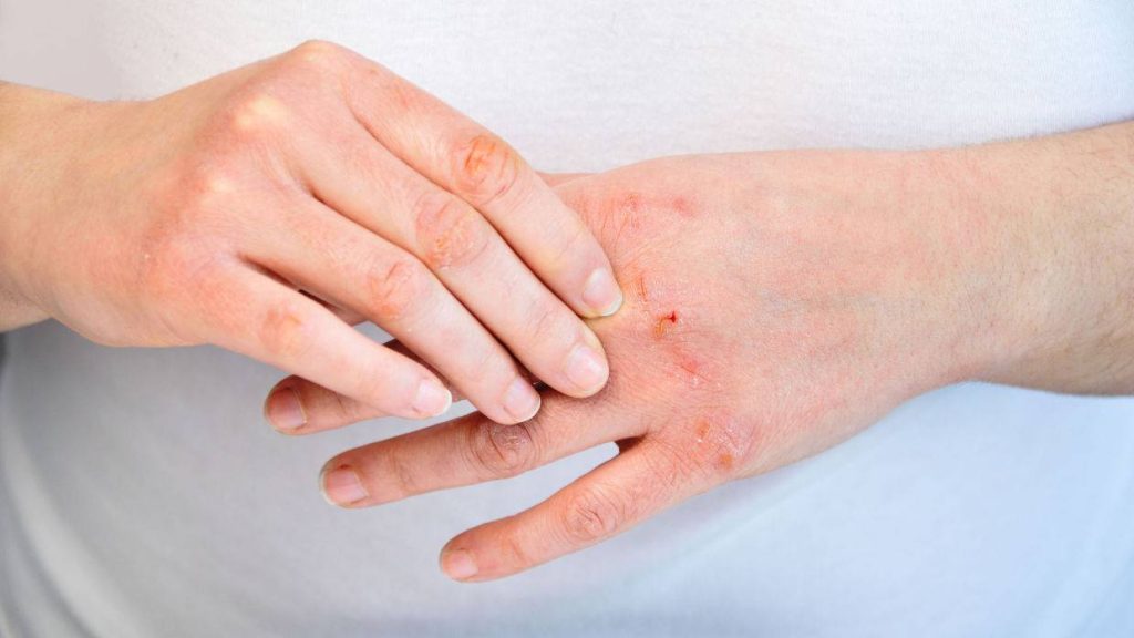 Πρόβλημα στα νεφρά: Τα σημάδια στα χέρια που δεν πρέπει να αγνοήσετε