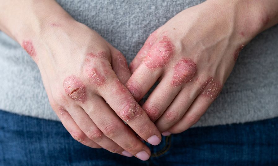 Ψωρίαση: Πώς συνδέεται με τη διατροφή – Τι να τρώτε και τι όχι