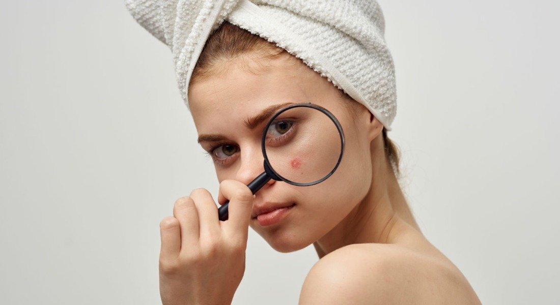 Αζελαϊκό οξύ: Το συστατικό που υπόσχεται να σε βοηθήσει με την ακμή