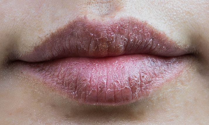 Σκασμένα χείλη: Πώς να τα προλάβετε και πώς να τα αντιμετωπίσετε