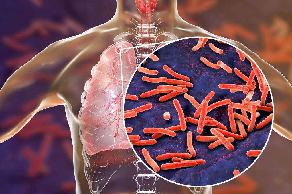 ΠΟΥ: Η φυματίωση επιστρέφει σε όλο τον κόσμο