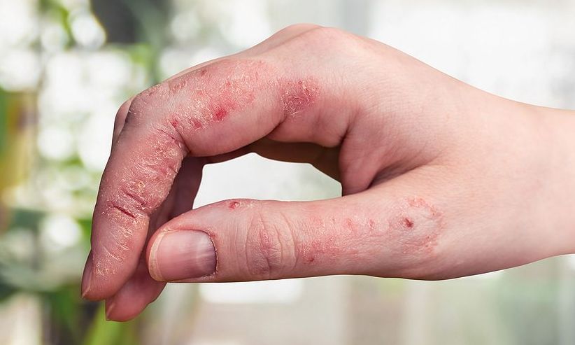 Πώς επηρεάζει η ψωρίαση την ψυχική υγεία των πασχόντων – Τι κίνδυνοι υπάρχουν