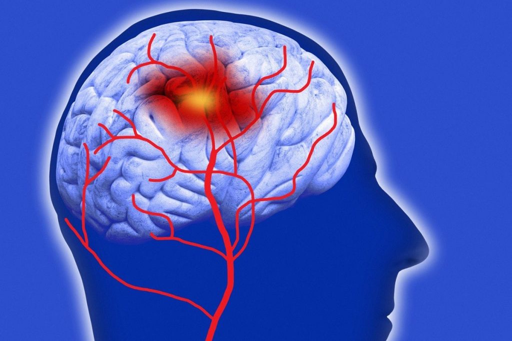 Υπαραχνοειδής αιμορραγία: Όσα πρέπει να γνωρίζετε για τον θανατηφόρο τύπο εγκεφαλικού – Ποια τα συμπτώματα