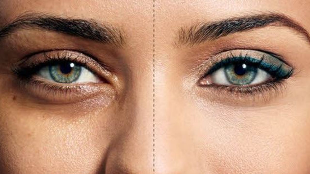 Με αυτούς τους φυσικούς τρόπους θα αντιμετωπίσετε τις «σακούλες» κάτω από τα μάτια