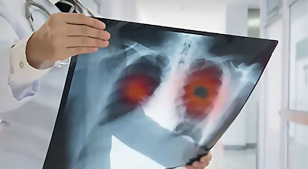 Αναπνευστικός συγκυτιακός ιός (RSV): Συμπτώματα που πρέπει να γνωρίζετε – Τι μπορείτε να κάνετε