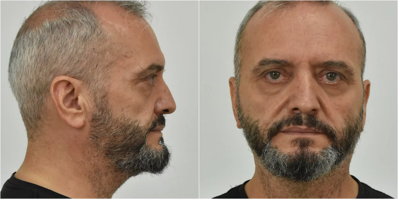 Υπόθεση μαστροπείας στον Κολωνό: «Δεν έχω δει ποτέ το Μίχο» λέει ο ιδιοκτήτης μοτέλ