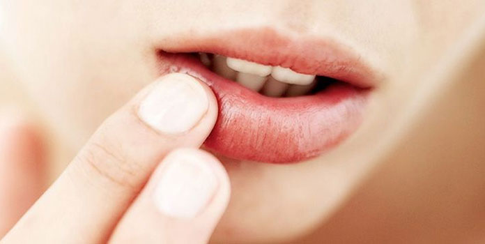 Σκασμένα χείλη: Τι πρέπει να κάνεις για να είναι ξανά απαλά