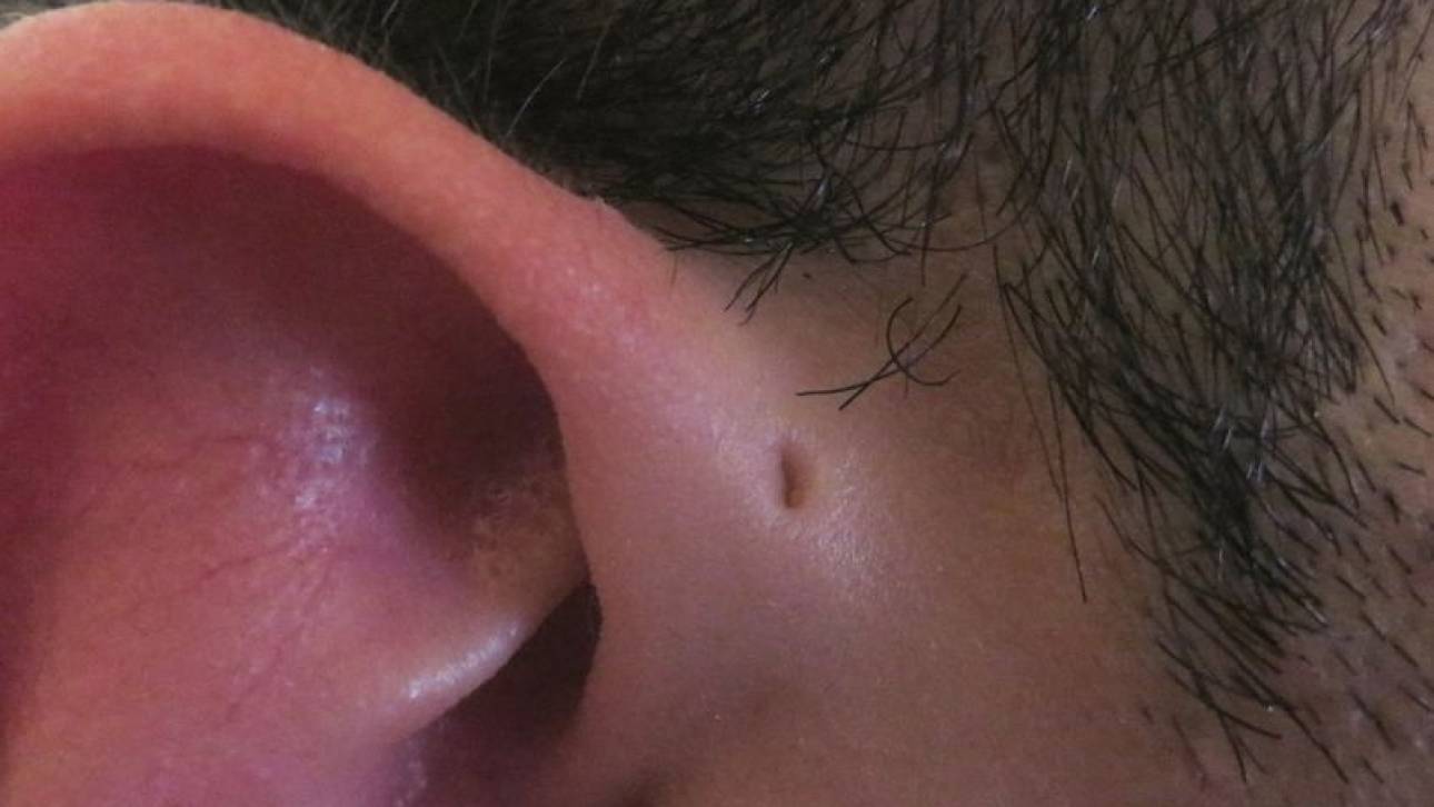 Προαυλικός κολπίσκος: Γιατί κάποιοι έχουν αυτή τη μικροσκοπική τρύπα πάνω από το αυτί;