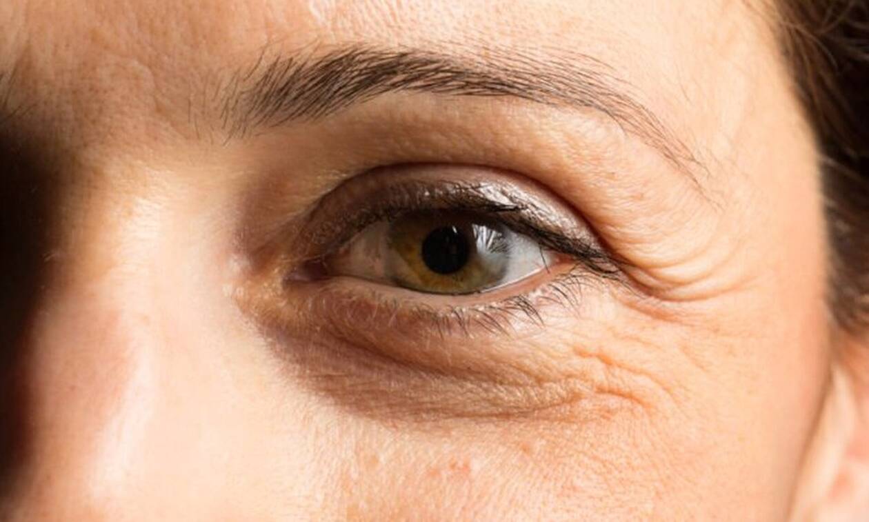 Τρόποι για να μειώσετε τις ρυτίδες κάτω από τα μάτια – Πώς να τις προλάβετε