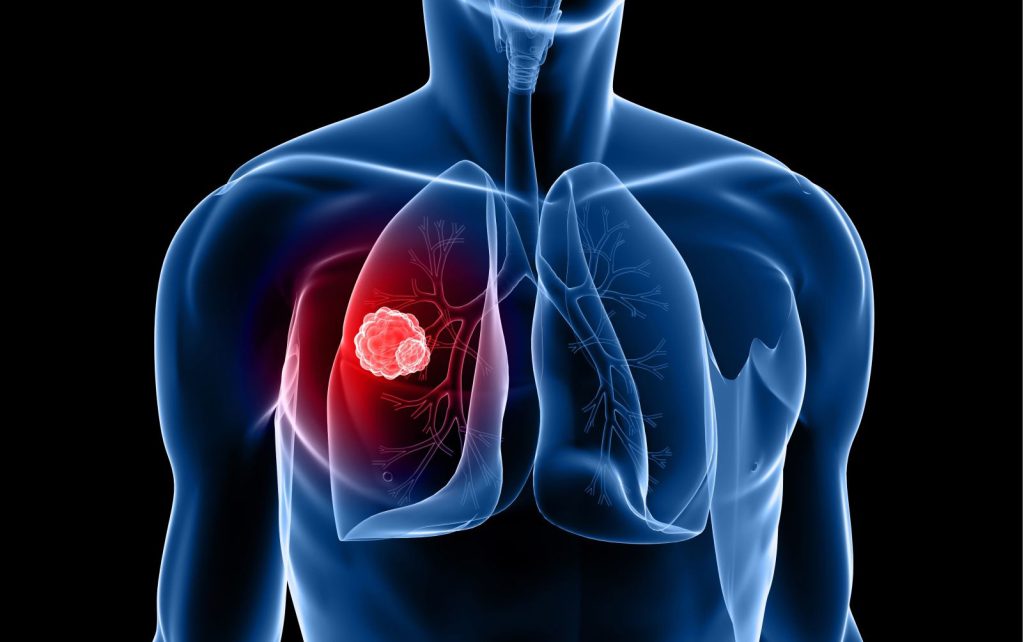 Όσα πρέπει να ξέρετε για τον μικροκυτταρικό καρκίνο του πνεύμονα: Ποια είναι τα πρώτα σημάδια και συμπτώματα
