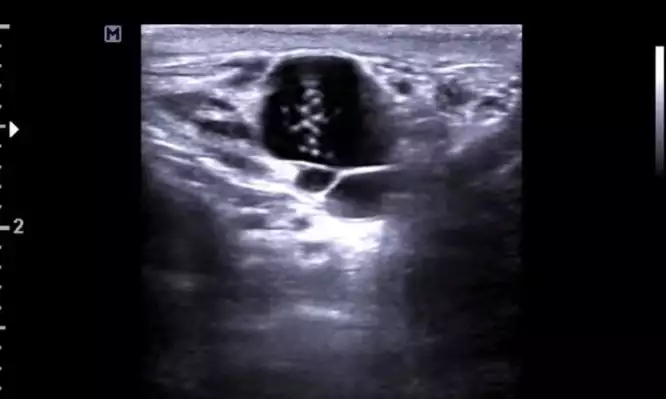 Τρομακτικό: Γιατροί είδαν σε υπέρηχο σκουλήκια να «χορεύουν» στο όσχεο 26χρονου (βίντεο)