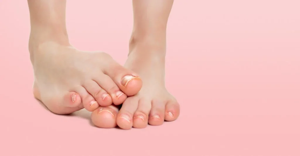 Τι προκαλεί τους μύκητες στα δάχτυλα των ποδιών – Ποια είναι η καλύτερη θεραπεία