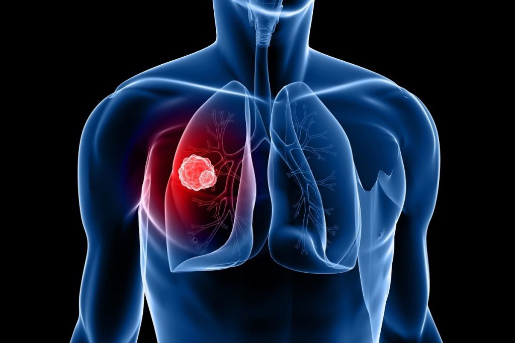Καρκίνος του πνεύμονα: Επιστήμονες εφηύραν νέα συνδυαστική προσέγγιση βακτηριακής θεραπείας