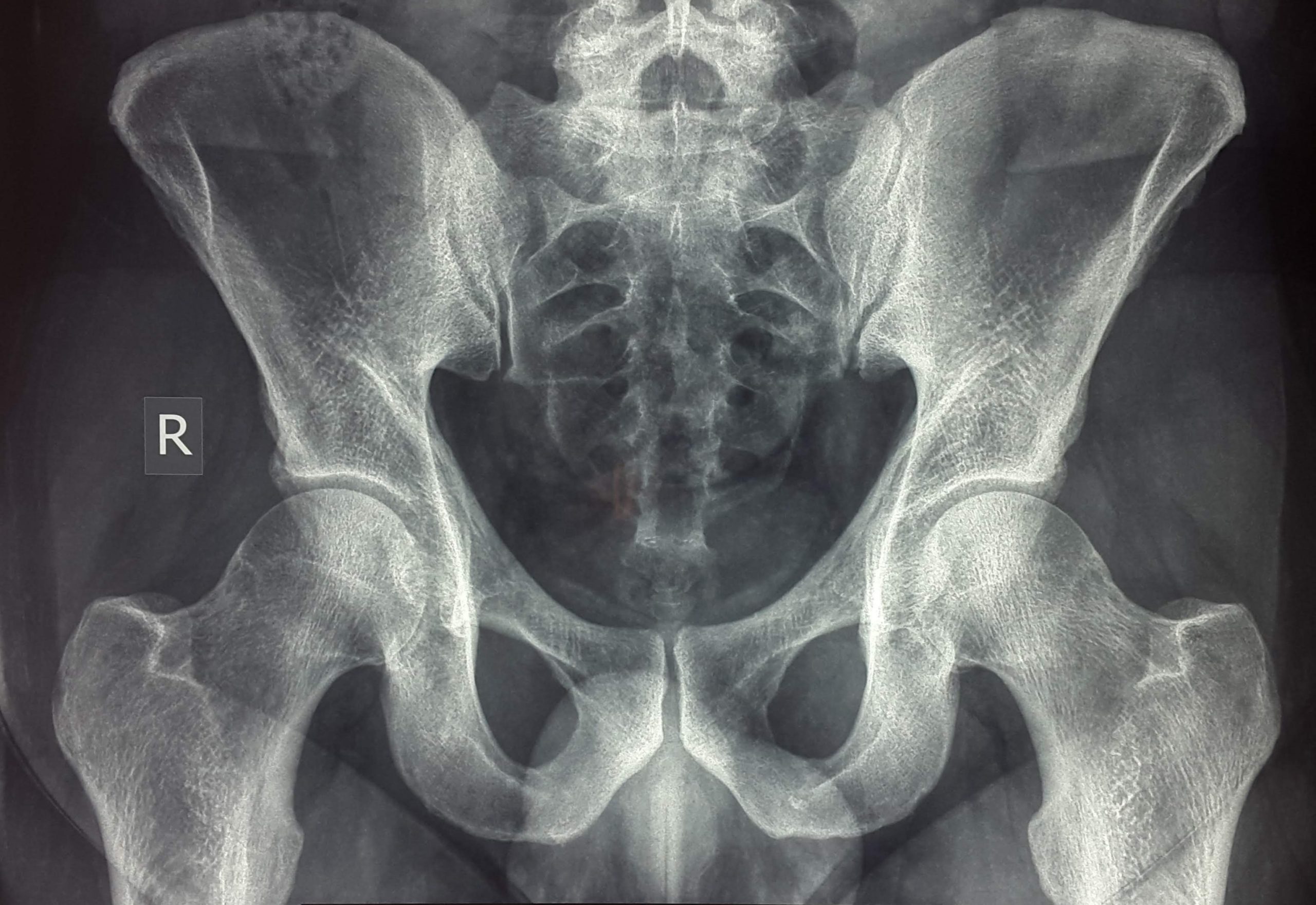 Οστεοαρθρίτιδα ισχίου: Ποιοι είναι οι βασικοί παράγοντες κινδύνου