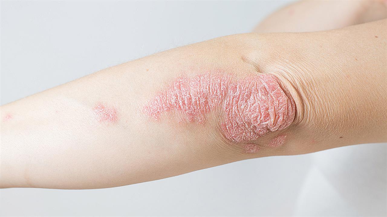 Ψωρίαση: Αυτό είναι το λιπίδιο που αυξάνει την ευαισθησία στον πόνο