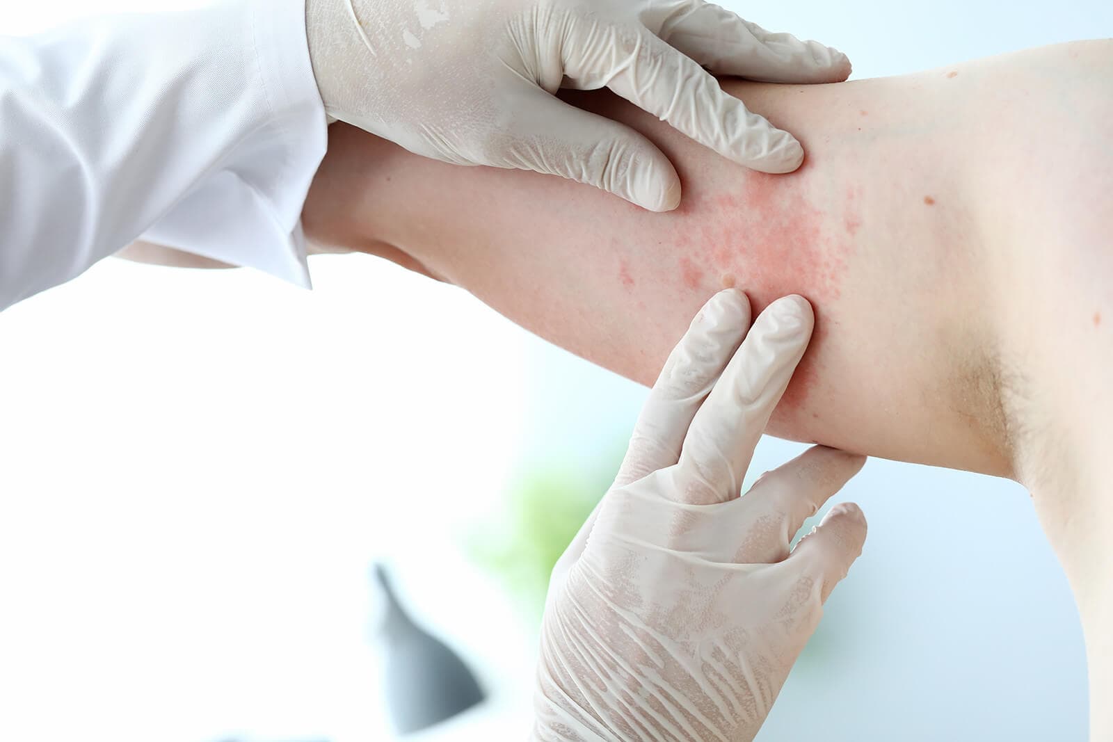 Έκζεμα ή ψωρίαση: Διαφορές και σύγκριση στα συμπτώματα