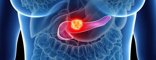 Χρόνια παγκρεατίτιδα: Όσα πρέπει να προσέχουν οι ασθενείς μετά το χειρουργείο – Τι έδειξε μελέτη