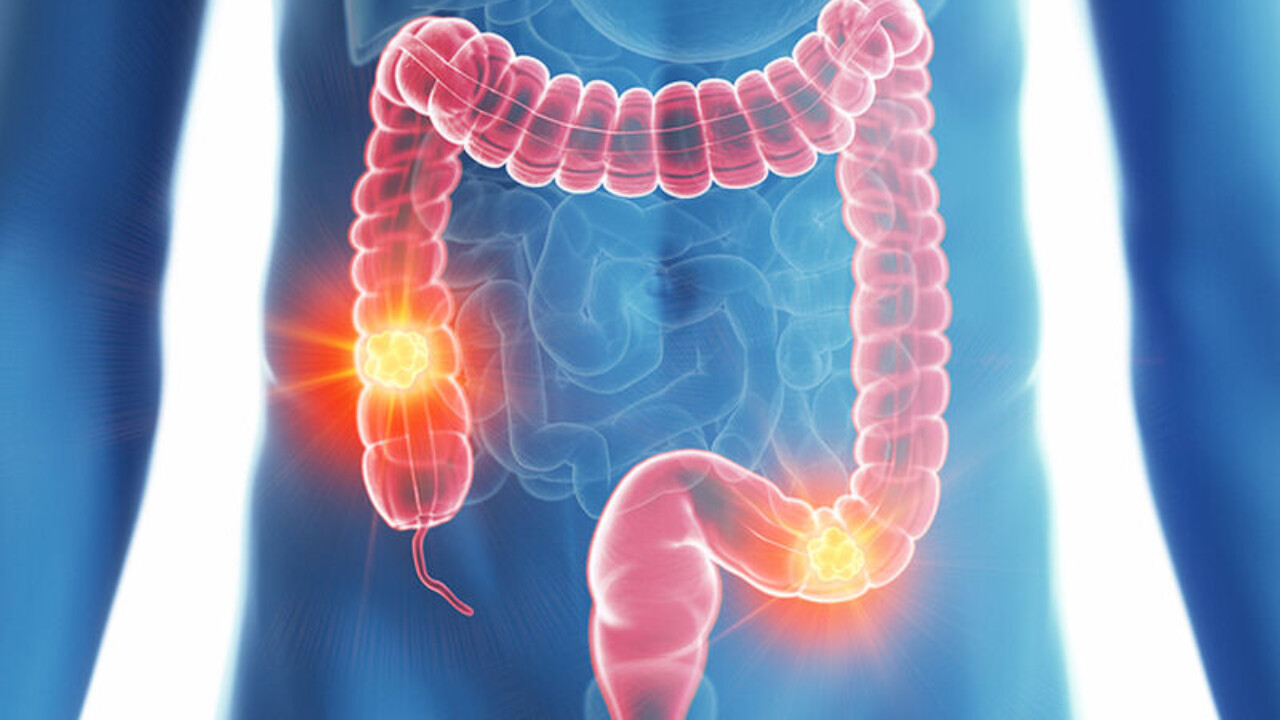 Καρκίνος παχέος εντέρου: Αυτές είναι οι επιπτώσεις που έχουν οι ασθενείς στη σεξουαλική τους ζωή