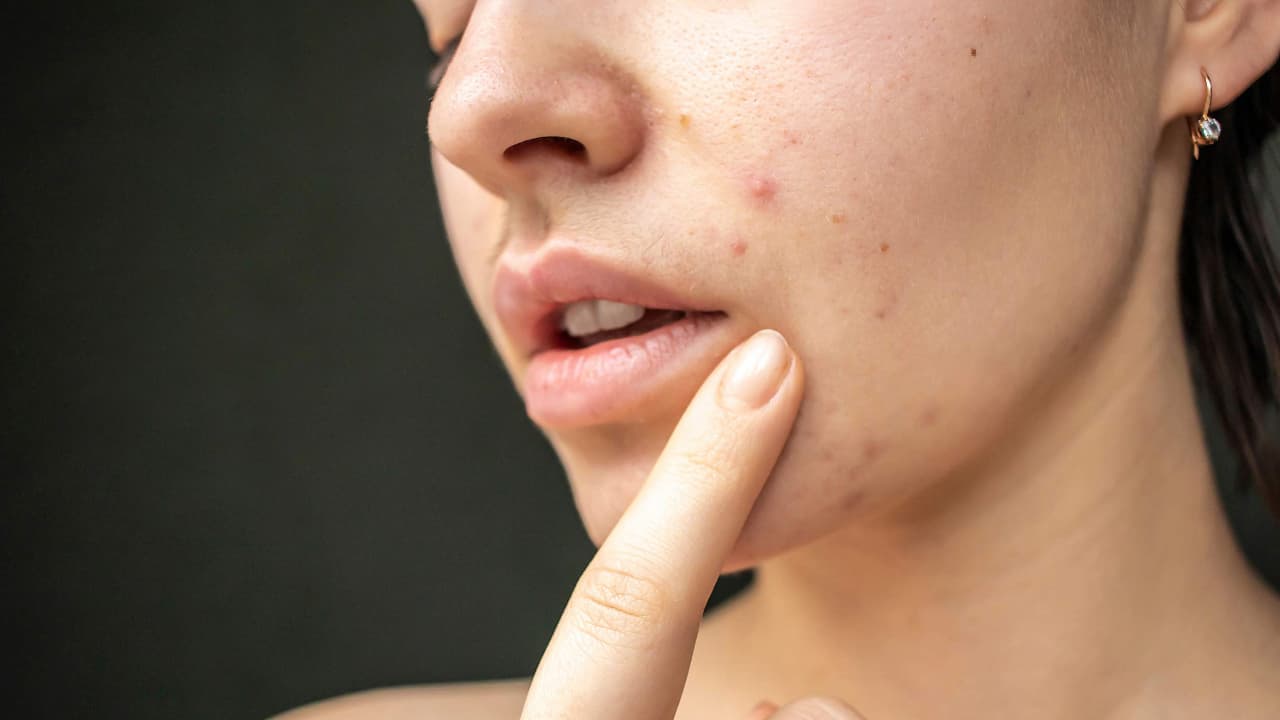 Ορμονική ακμή: Τι ακριβώς είναι και πώς μπορείς να την αντιμετωπίσεις