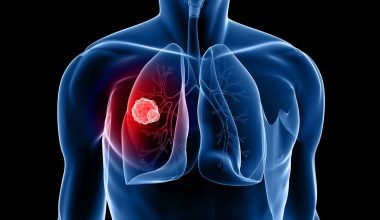 Καρκίνος του πνεύμονα: Αυτά είναι τα πιο κοινά συμπτώματα – Τι πρέπει να προσέξετε με τον βήχα