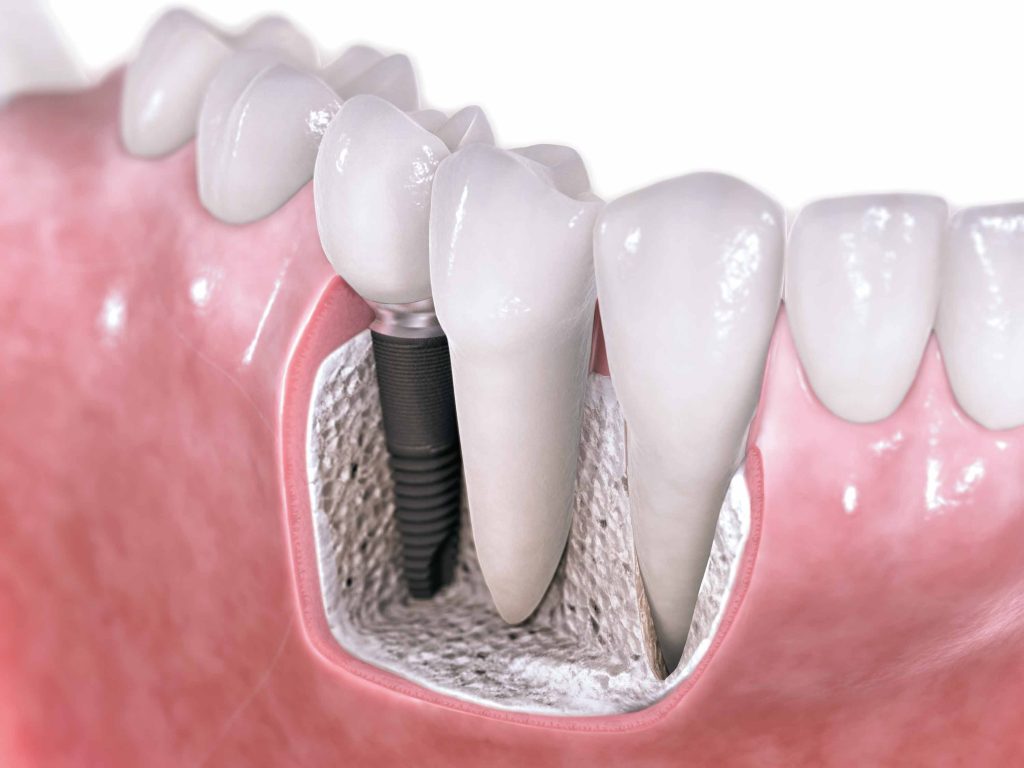 Ποια φάρμακα μπορούν να οδηγήσουν στην αποβολή των οδοντικών εμφυτευμάτων