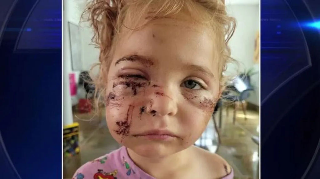 ΗΠΑ: Σκύλος επιτέθηκε σε 5χρονη στη Φλόριντα – Της έκαναν 50 ράμματα σε πρόσωπο, λαιμό και ώμους (φώτο-βίντεο)