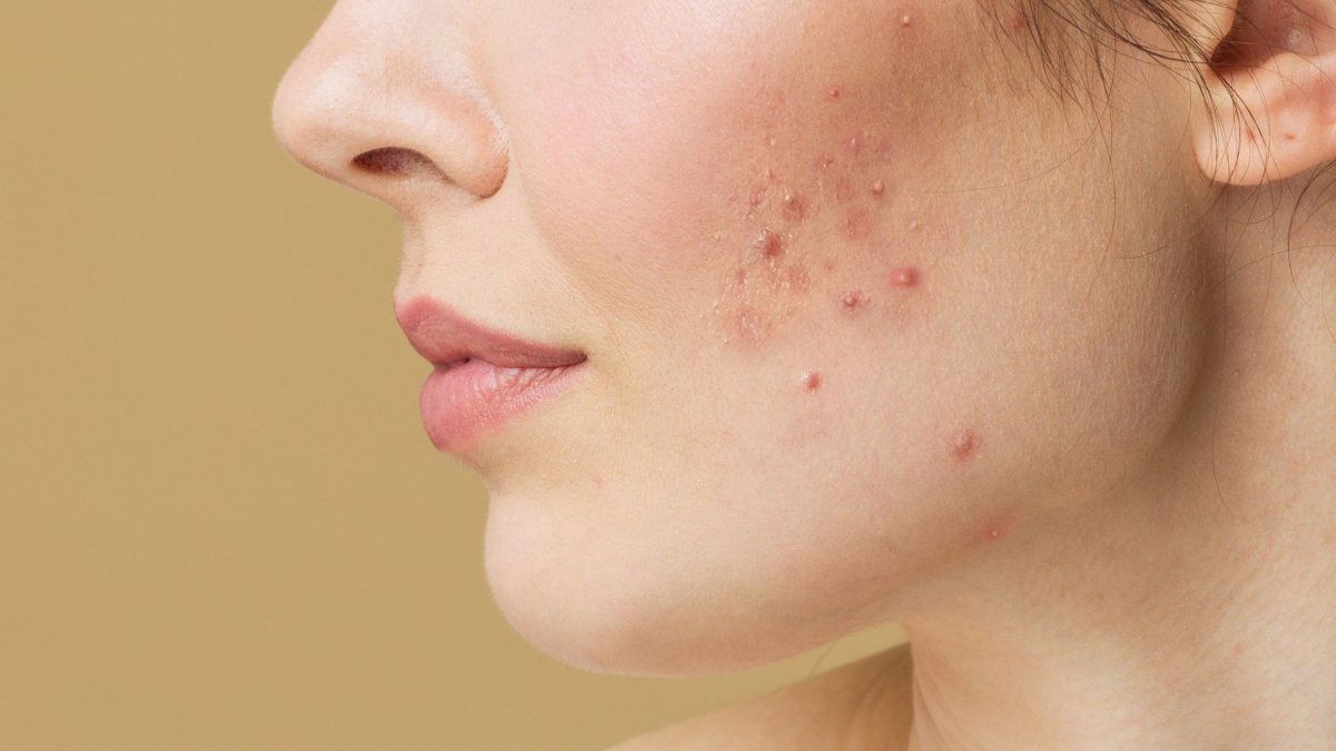 Ακμή: Το «θαυματουργό» φρούτο που μπορεί να σε σώσει