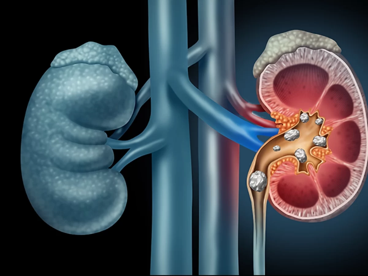 Ροφήματα που μπορούν να βοηθήσουν στη διατήρηση της υγείας των νεφρών