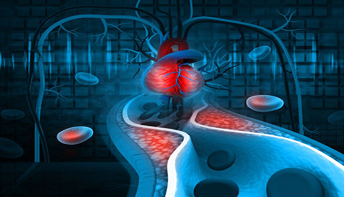 Πώς η υψηλή χοληστερόλη μπορεί να προκαλέσει θρομβώσεις;