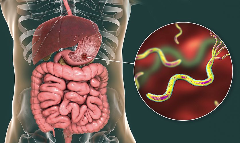 Έλκος στομάχου: Ποιες τροφές το επιδεινώνουν και ποιες το βελτιώνουν – Φυσικές και σπιτικές θεραπείες