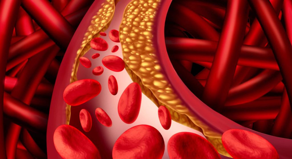 Πέντε τροφές που μπορούν να βοηθήσουν στη μείωση της «κακής» χοληστερόλης