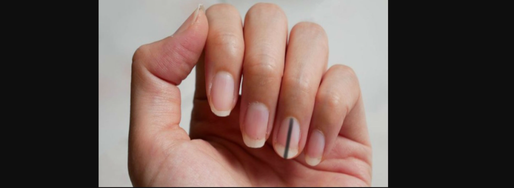 Μαύρη γραμμή στο νύχι: Τι μπορεί να σημαίνει και σε ποιες περιπτώσεις δεν πρέπει να την αγνοήσετε