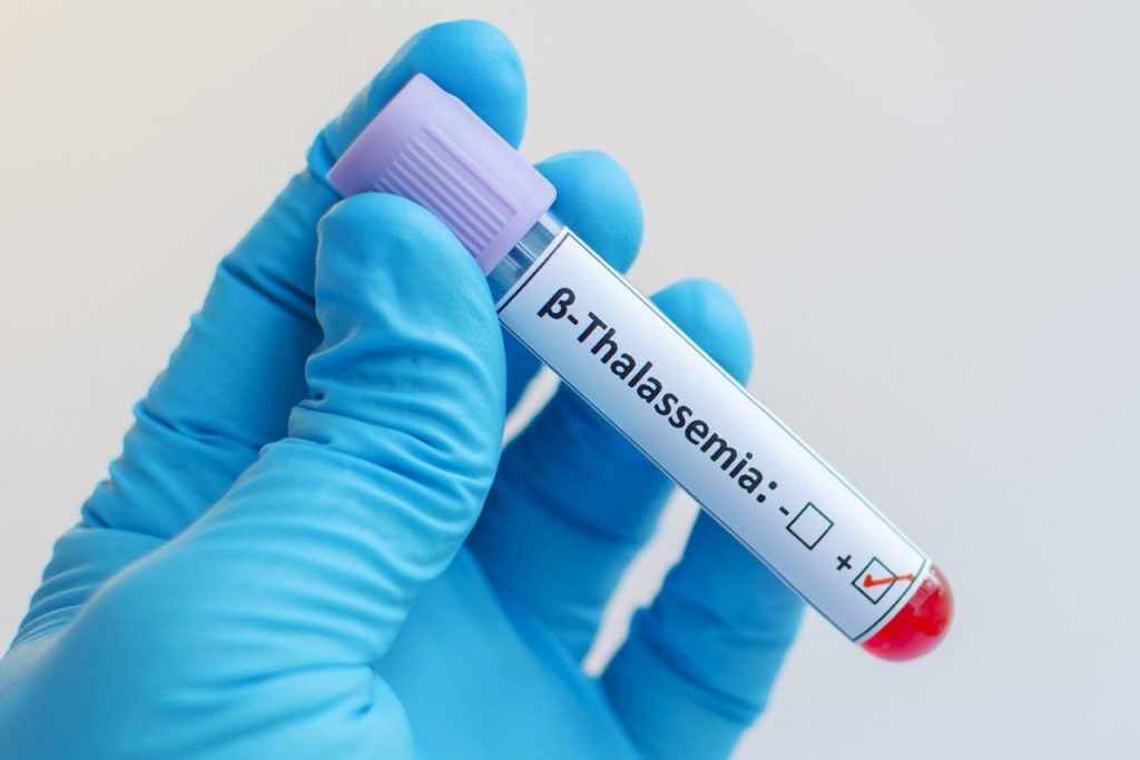 Η ΕΕ ενέκρινε το φάρμακο «luspatercept» για ασθενείς με β-θαλασσαιμία που δεν χρειάζονται μεταγγίσεις