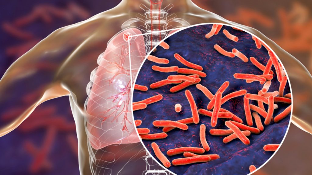 ΠΟΥ για τη φυματίωση: «Αυξάνεται ο αριθμός των νεκρών στην Ευρώπη»