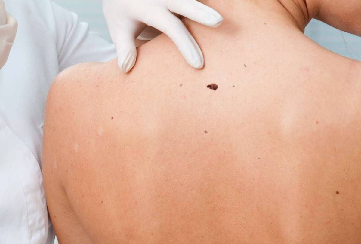 Βιταμίνη D: Ο ρόλος της και η σημασία στη μείωση κινδύνου για εμφάνιση μελανώματος