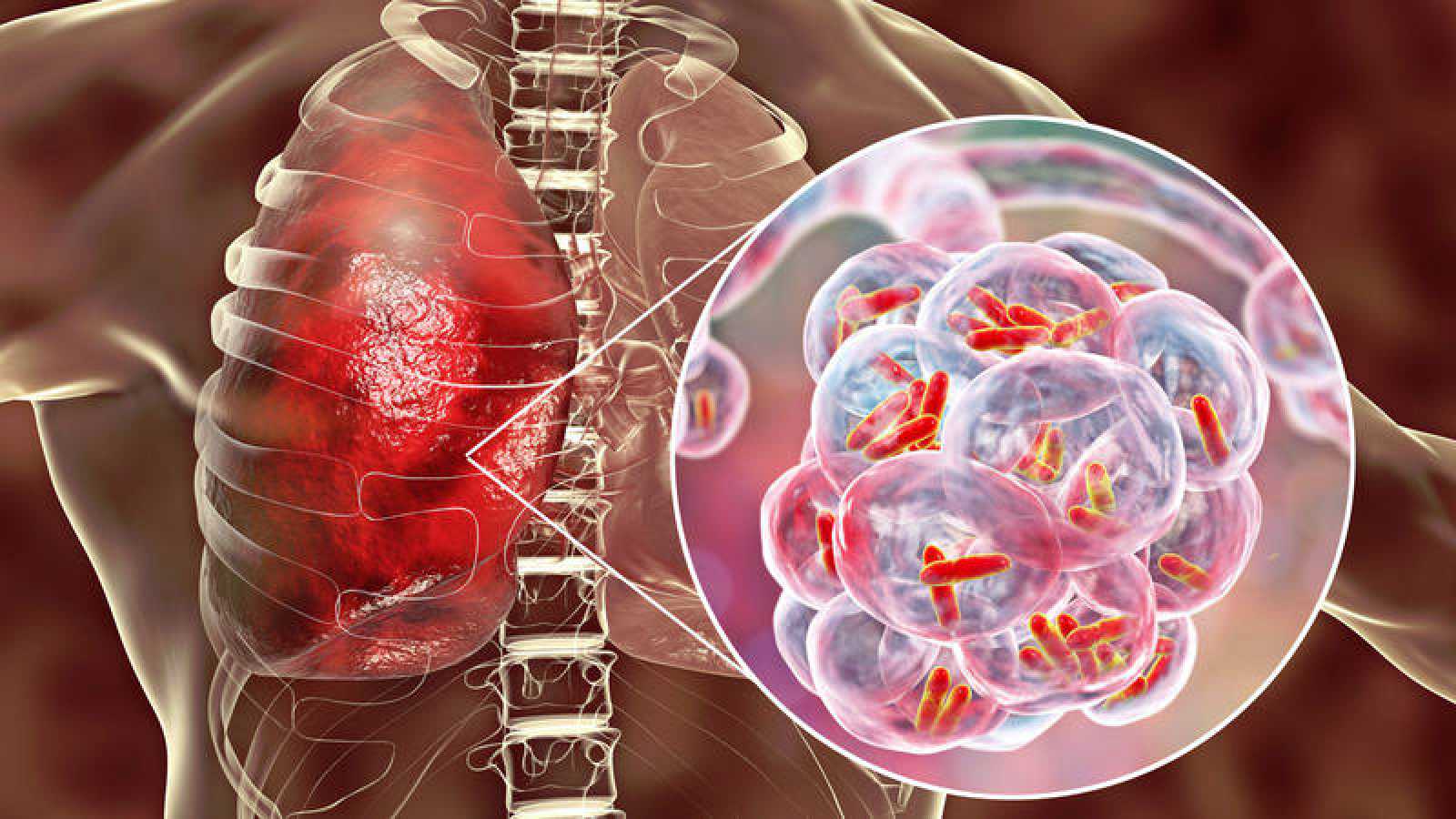 Φυματίωση: Αυτά είναι τα συμπτώματα που πρέπει να γνωρίζετε