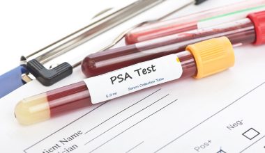 Πόσο ωφελεί ο τακτικός έλεγχος του PSA στην υγεία του προστάτη