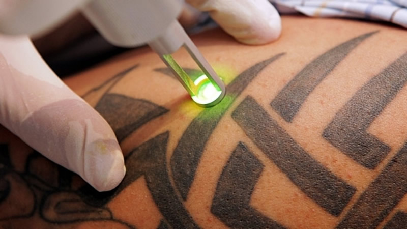 Αυτή είναι η κατάλληλη εποχή για την αφαίρεση τατουάζ