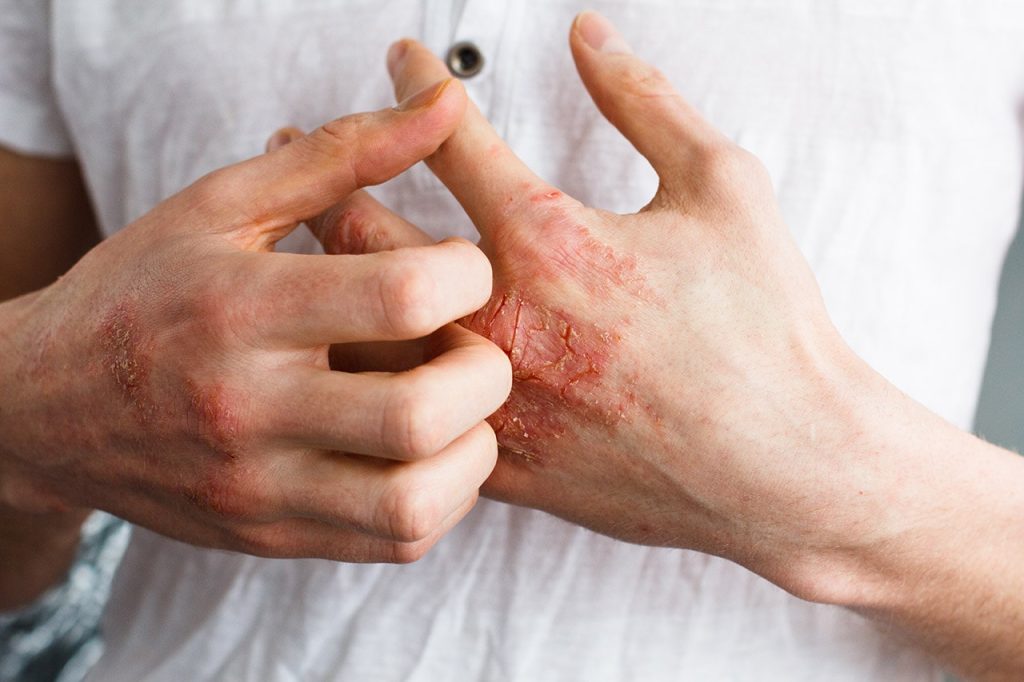 Μελέτη: Οι ενήλικες με ατοπική δερματίτιδα έχουν μεγαλύτερο κίνδυνο να εμφανίσουν καρκίνο του δέρματος